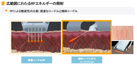 ブレシングの特長