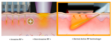 傾斜マイクロニードルによるサブシジョン効果