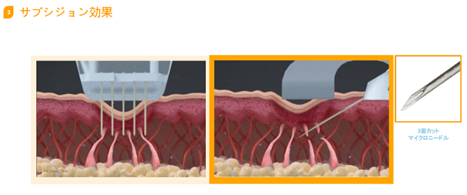 傾斜マイクロニードルによるサブシジョン効果