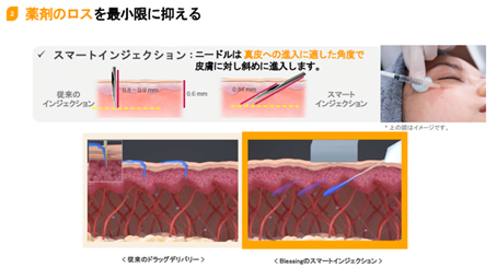 管腔ニードルによる薬剤のダイレクト導入
