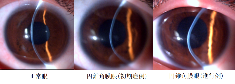 2) 細隙灯顕微鏡検査