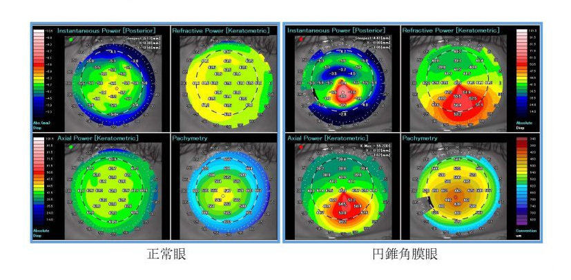 3) 角膜形状解析