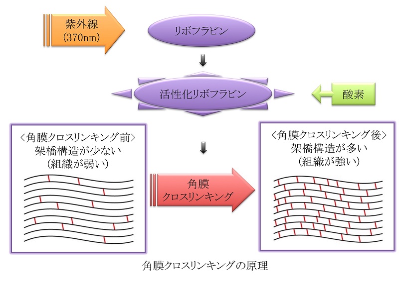 角膜クロスリンキング
