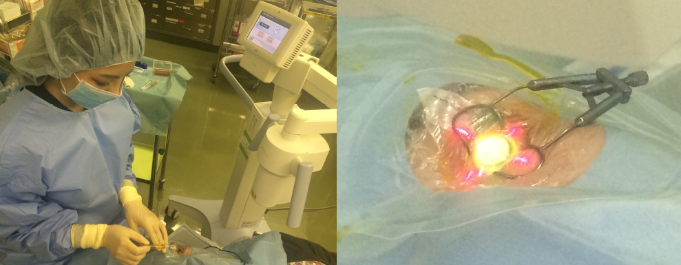 角膜クロスリンキングの手術方法