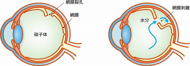 早期発見で「失明を防げる」目の病気